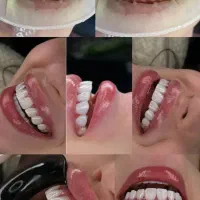 دندانپزشکی/اگردندان درد داری فقط تماس بگیر عصب کشی