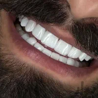 کامپوزیت دندان /طرح لبخند( اقساط)|خدمات آرایشگری و زیبایی|مشهد, راهنمایی|دیوار
