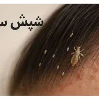 داروشپش.درمان شپش و رشک|آرایشی، بهداشتی، درمانی|گلبهار, شهر جدید گلبهار|دیوار