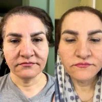 جشنواره اندولیفت کل صورت