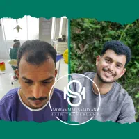 تیم کاشت مو ، ابرو و ریش شیراز در شهر رشت