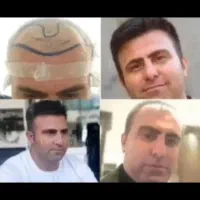 کاشت مو وابروی تخصصی فقط با مبلغ ۲۰ میلیون تومان