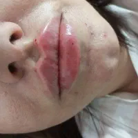 خدمات زیبایی ژل وبوتاکس ومزو آنزیم وکاشت نخ مونو