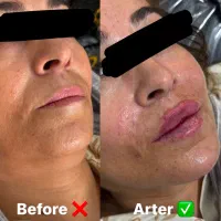 تزریقات زیبایی فیلر ، بوتاکس ، prp