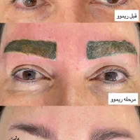 ریموو و پاک‌کردن تخصصی تاتو (تتو) ابرو بدون لیزر|خدمات آرایشگری و زیبایی|شیراز, معالی‌آباد|دیوار