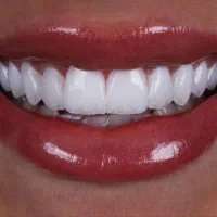 کامپوزیت دندان با بهترین کیفیت|خدمات آرایشگری و زیبایی|تهران, آرژانتین|دیوار