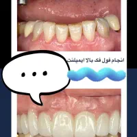 ایمپلنت تخصصی از ۷میلیون+ اوردنچر/ تخفیف تاآخرآذر|خدمات آرایشگری و زیبایی|اصفهان, جلفا|دیوار