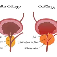 بهبود پروستات و مشکلات آقایان