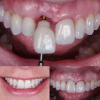 ایمپلنت و خدمات دندانپزشکی با شرایط ویژه و اقساط
