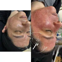 اسید تراپی تخصصی