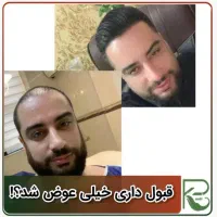 کاشت مو ابرو ریش تارکوب