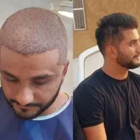 کاشت مو و ابروی طبیعی مزو و پی آرپی جلوگیری ریش مو|خدمات آرایشگری و زیبایی|تبریز, |دیوار