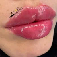ژل و بوتاکس خانم ها و آقایون با ۸ سال سابقه