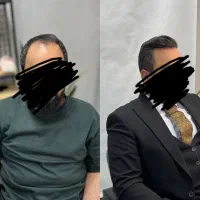 حراج پروتز موی شقیقه