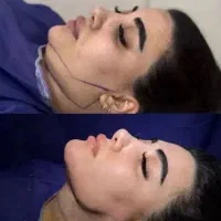 زاویه سازی فک وچربی