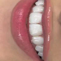 کامپوزیت دندان .۰لیرینگ .لمینت .ونیر