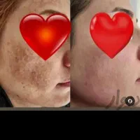 کرم سوپر معجزه صدرصد اصلی و ضمانتی