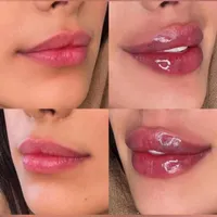 تزریق ژل لب بوتاکس لیفت نخ آنزیم کانتورینگ ساکشن|خدمات آرایشگری و زیبایی|تهران, صادقیه|دیوار