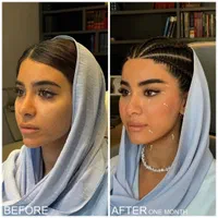 مزوژل فیلر بینی ژل لب بایو فیلر بوتاکس آنزیم گونه