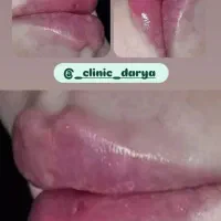 تزریق ژل و بوتاکس در مطب