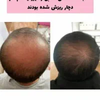 درمان ریزش و رویش مجدد مو|آرایشی، بهداشتی، درمانی|لاهیجان, بازکیاگوراب|دیوار