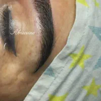 کاشت ابرو سر و ریش تخصصی تضمینی