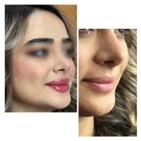 تزریق فیلر لب با متدهای ترند اینستا - دکتر واحدی|خدمات آرایشگری و زیبایی|قزوین, |دیوار