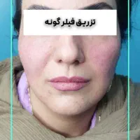 خدمات زیبایی تزریق فیلر ،بوتاکس و لیزر در مطب پزشک|خدمات آرایشگری و زیبایی|قم, نیروگاه|دیوار