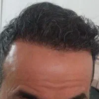 کاشت مو با روش میکروگرفت