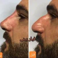 زیبایی لیفت بلفارو فرم بینی بوتاکس نخ ابروزاویه ژل|خدمات آرایشگری و زیبایی|اصفهان, خانه اصفهان|دیوار