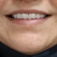 دندانپزشکی از دم قسط ایمپلنت کامپوزیت عصبکشی روکش|خدمات آرایشگری و زیبایی|خرمآباد, |دیوار