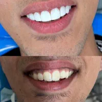 کامپوزیت دندان جشنواره ی تخفیفات تا شب یلدا|خدمات آرایشگری و زیبایی|رشت, معلم|دیوار