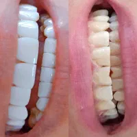 کامپوزیت دندان