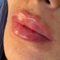 تزریقات فیلر و بوتاکس توسط پزشک|خدمات آرایشگری و زیبایی|تهران, جوادیه|دیوار