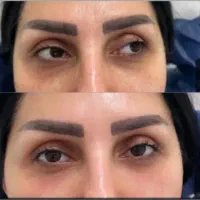ژل و بوتاکس فیلر مزو ژل مزو تخفیف ویژه فول فیس|خدمات آرایشگری و زیبایی|مشهد, ملک‌آباد|دیوار