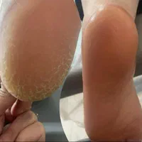 تخفیف در لاین کراتین و احیا.پدیکور.پاکسازی و فشیال|خدمات آرایشگری و زیبایی|کرمانشاه, |دیوار