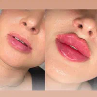 کرمپودر دائم و ژل و بوتاکس و هایفو|خدمات آرایشگری و زیبایی|اهواز, کیانپارس |دیوار