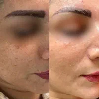 فیشال تخصصی پوست تکنیک‌گلس اسکین