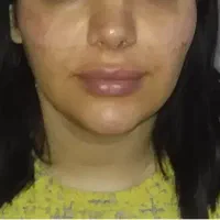 تزریق ژل وبوتاکس ژل لب گونه چانه زاویه خط لبخند|خدمات آرایشگری و زیبایی|کرمانشاه, |دیوار