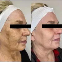 درمان تضمینی لک و کک و مک و خال /فقط در 1 جلسه|خدمات آرایشگری و زیبایی|اصفهان, لاله|دیوار