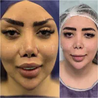 لیفت ابرو/سانترال/بلفاروپلاستی/کاشت ابرو/ساکشن