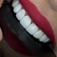 دنتال امیر(کامپوزیت دندان ازدم قسط)