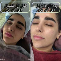 جشنواره فیشیال . پاکسازی.مزو با قیمت استثنایی ۲۸۰
