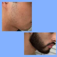 سرم رویش ریش سیبیل و موسر