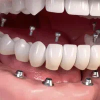 ایمپلنت فوری/اوردنچر/با گارانتی/اقساط ۶-۱۵ ماهه