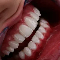 جشنواره تابستانه دندانپزشکی با 10% تخفیف