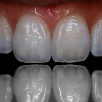 قسطی لب شیشه لیرینگ لمینیت جدید متفاوت دندان زیبا|خدمات آرایشگری و زیبایی|مشهد, سجاد شهر|دیوار