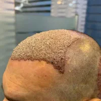 کاشت مو و ابرو ریمو تتو با دستگاه پیشرفته اهواز|خدمات آرایشگری و زیبایی|خرمشهر, |دیوار