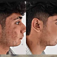 جای جوشاتو ببر بدون لیزر