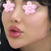 ژل بوتاکس مزو انزیم